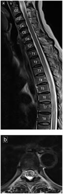 Case Report: Acute Spinal Cord Myelopathy in Patients With COVID-19